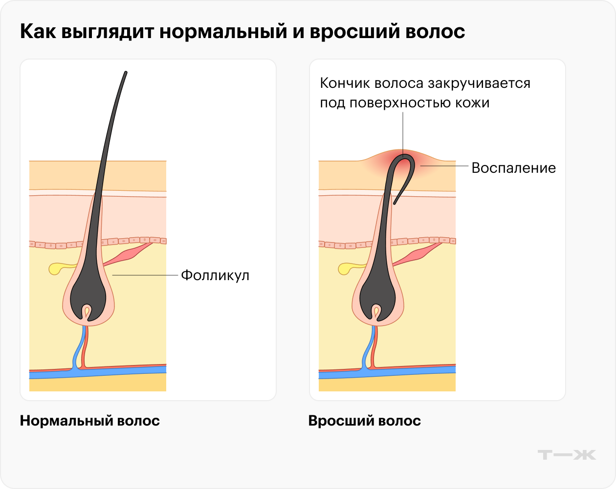 Вросшие волоски — те, что в процессе роста не пробились сквозь кожу, а продолжили расти под ней, врастая или закручиваясь. Это приводит к появлению красных воспаленных бугорков