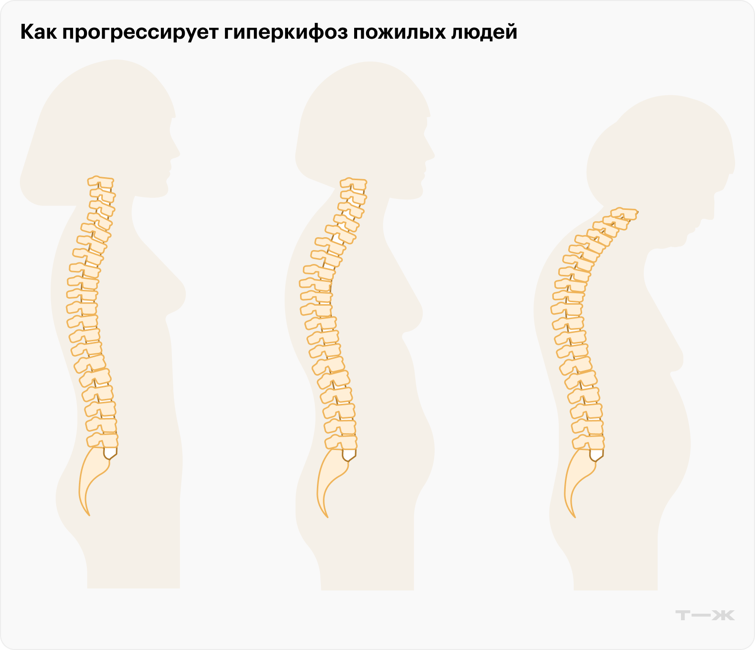 Гиперкифоз развивается постепенно. Первые признаки состояния становятся заметны примерно в середине жизни. К старости гиперкифоз может начать быстро прогрессировать и превратиться в настоящий горб