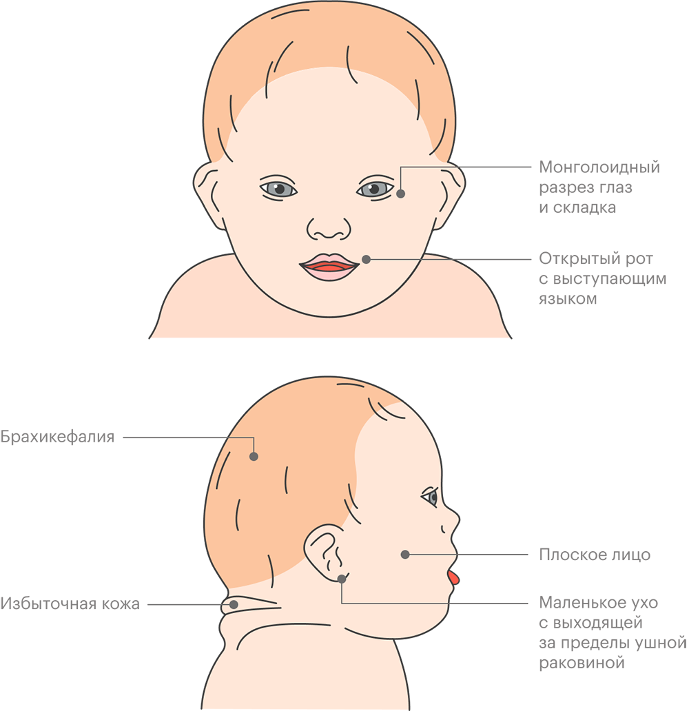 Большинству людей с синдромом Дауна присущи такие черты: плоское лицо, короткая шея и нос, маленькие уши, открытый рот. У каждого человека те или иные черты будут выражены в разной степени