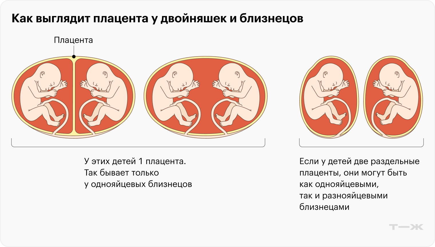 Часто по плаценте врачи могут понять, кем дети приходятся друг другу — двойняшками или близняшками