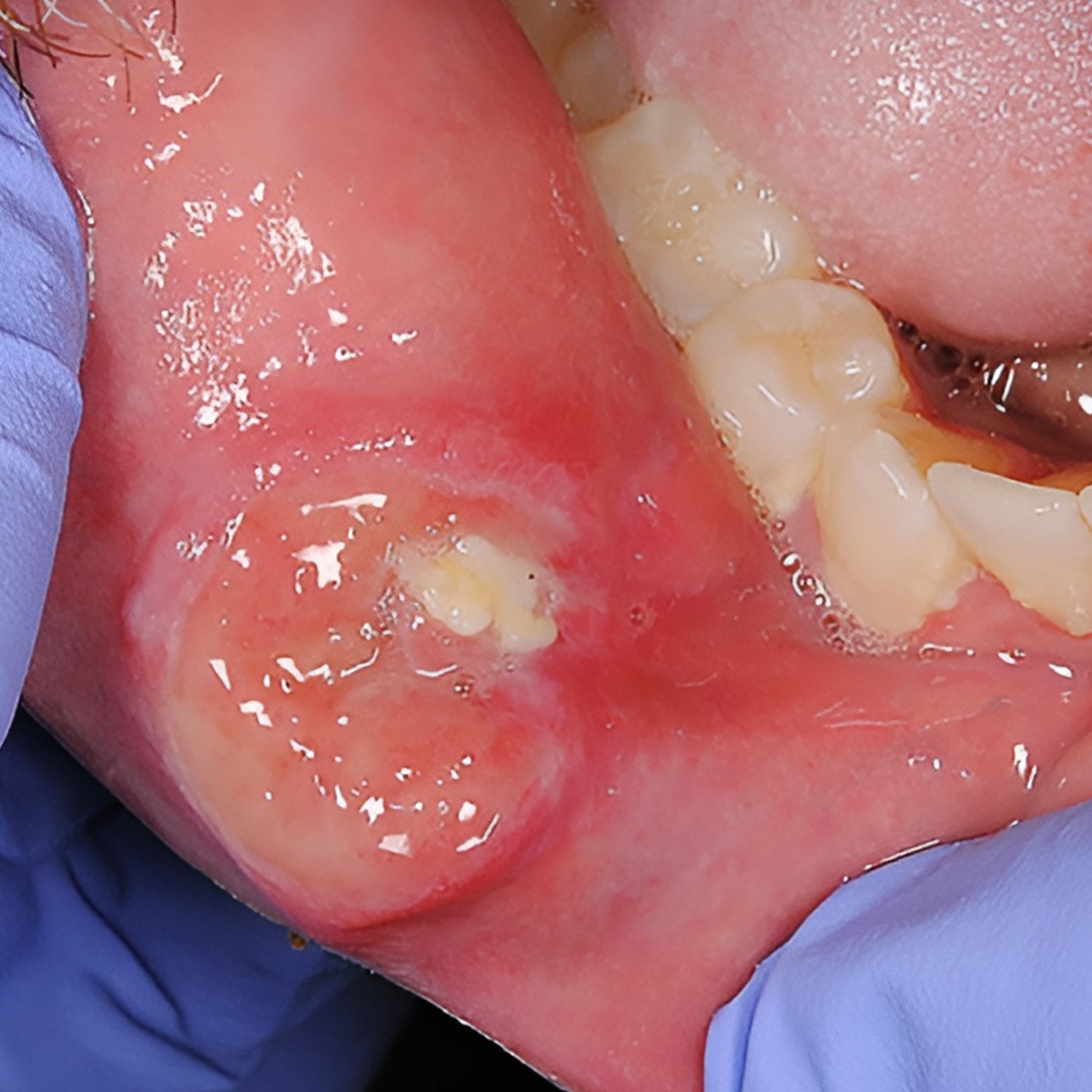 Шанкр на губе при первичном сифилисе. Источник: pubmed.ncbi.nlm.nih.gov