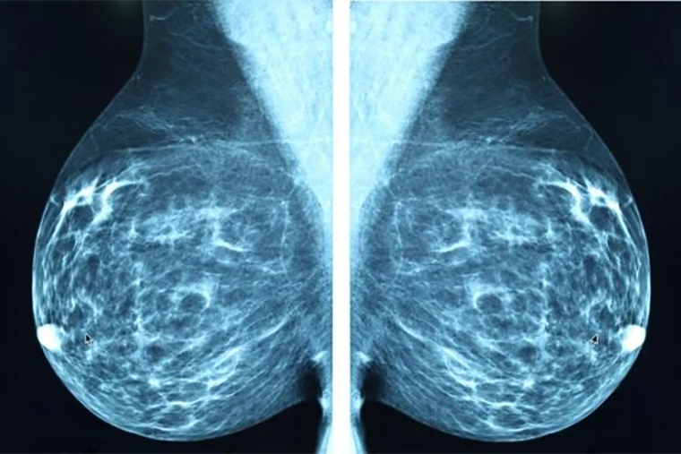 Снимок молочной железы, полученный методом рентгеновской маммографии. Качество изображения гораздо выше, чем у снимка, полученного при помощи электроимпеданса. Источник: itnonline.com