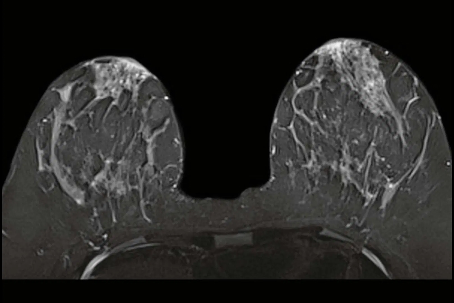 Снимок молочной железы, полученный методом МРТ. Качество изображения тоже гораздо выше, чем у снимка, полученного при помощи электроимпеданса. Источник: siemens-healthineers.com
