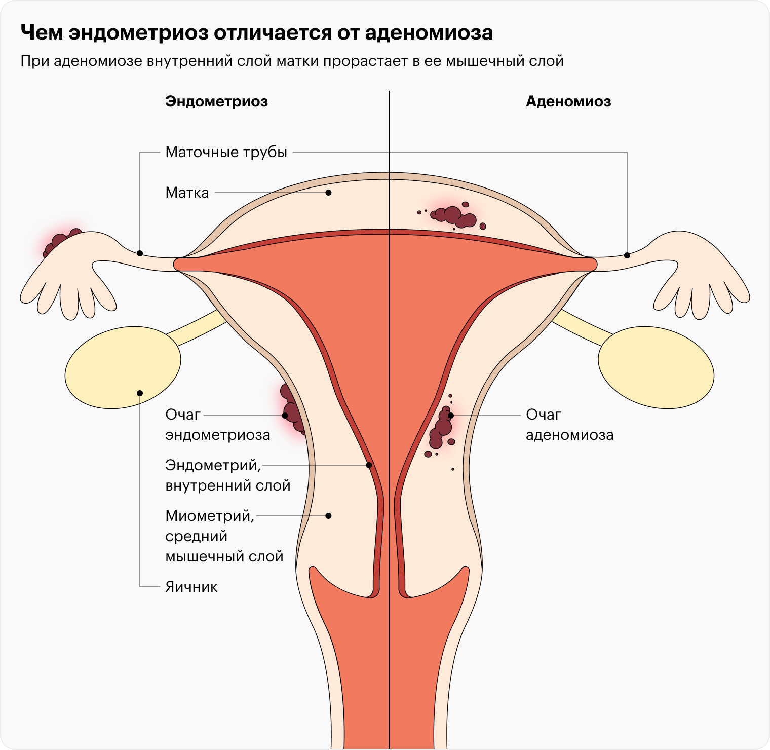 Лечение эндометриоза в ведущих центрах и клиниках России