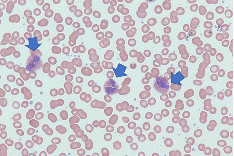 Синими стрелочками показаны эозинофилы — так они выглядят в мазке крови. Здесь эозинофилов уже много. Источник: The Blood Project