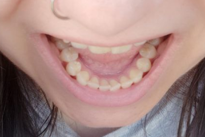 Фото зубов до процедуры