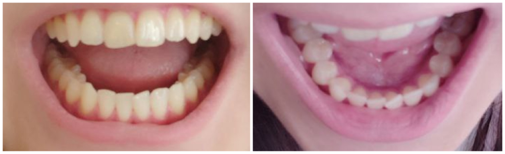 Мои зубы после процедуры. Никаких царапин
