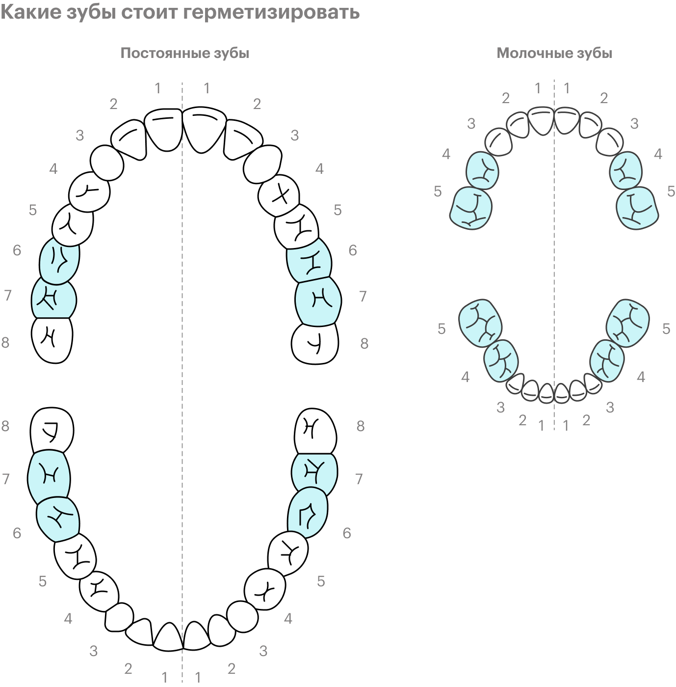 Герметизация обычно нужна постоянным «шестеркам» и «семеркам». Иногда герметизируют и молочные зубы — 5 и 4