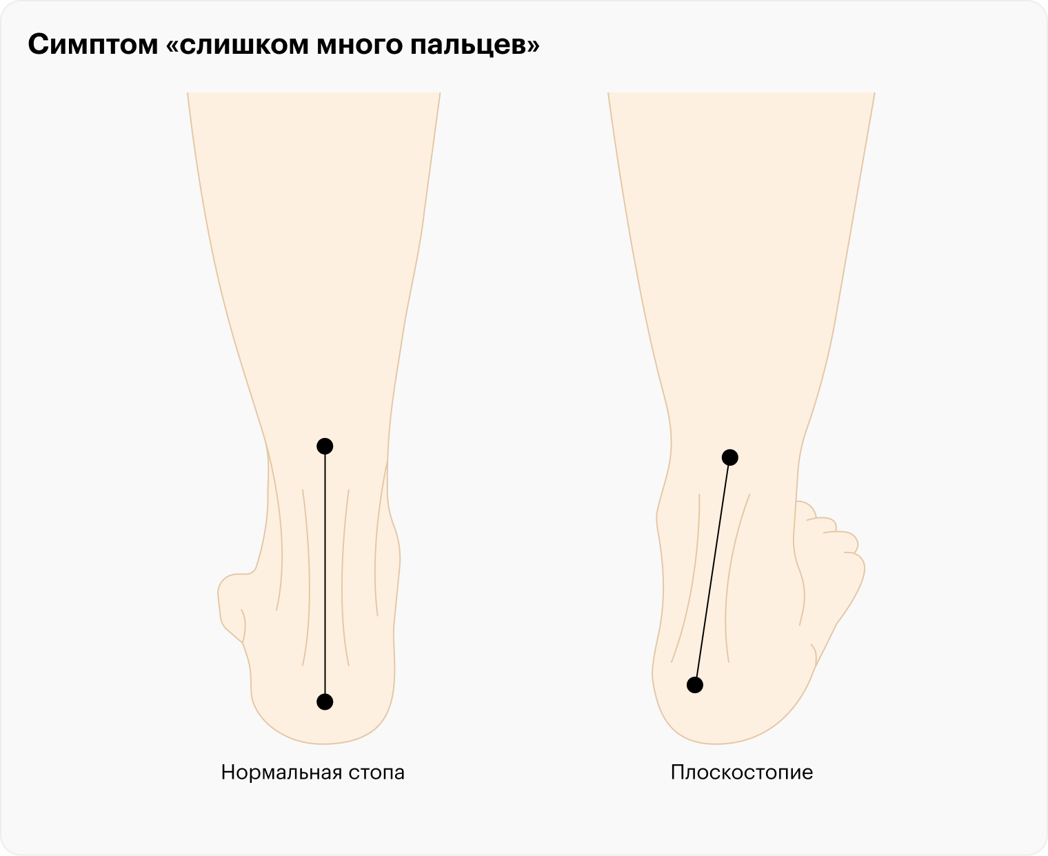 Упражнения для укрепления стоп при плоскостопии | блог Olvi - Статьи сайта - полезная информация