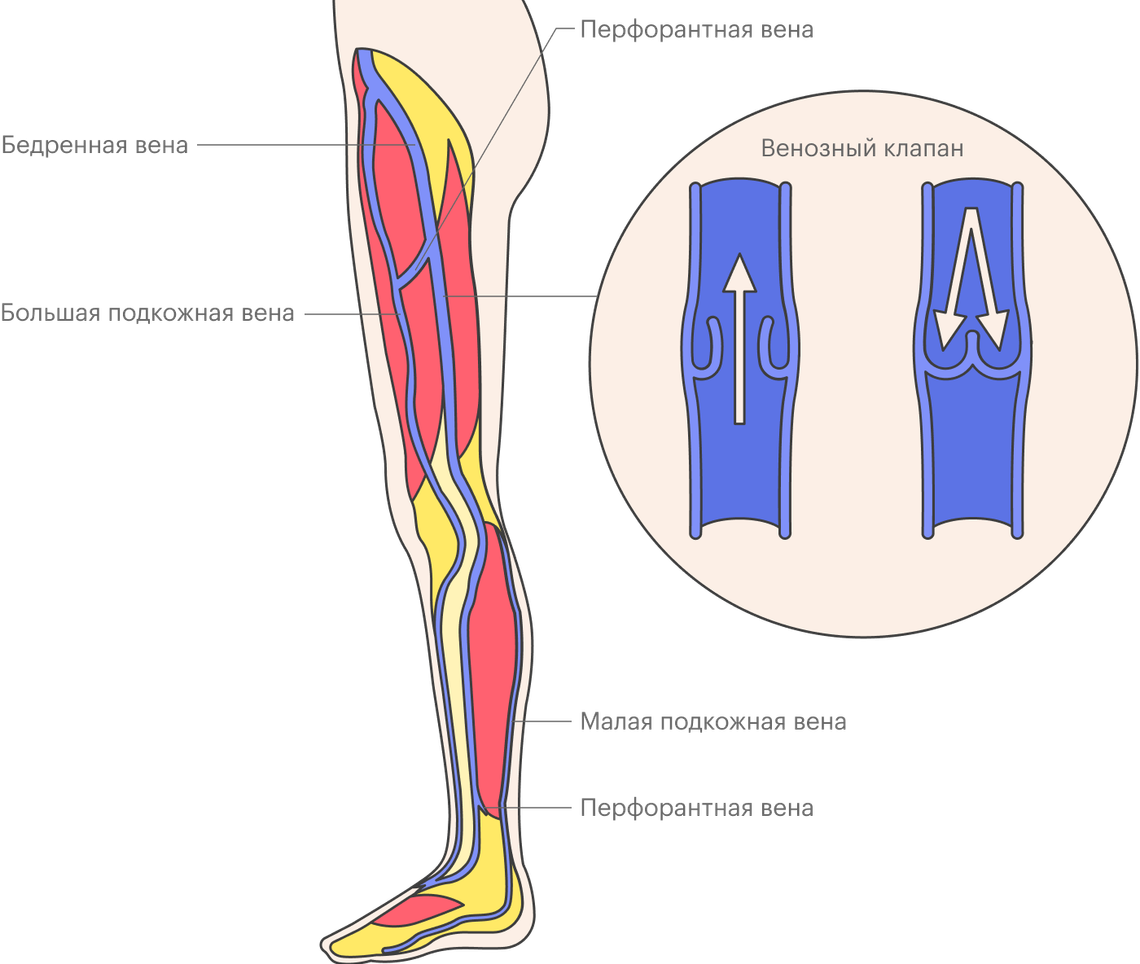 Вопросы флебологу: почему появляется варикоз и как его предотвратить,  причины тромбоза