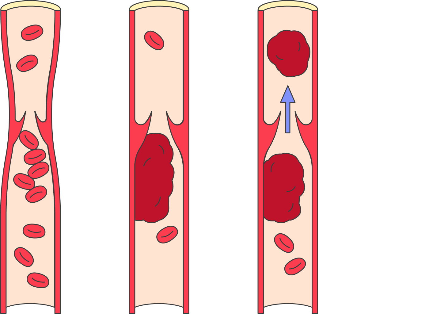 Закупорка артерии тромбом. Размеры тромбов