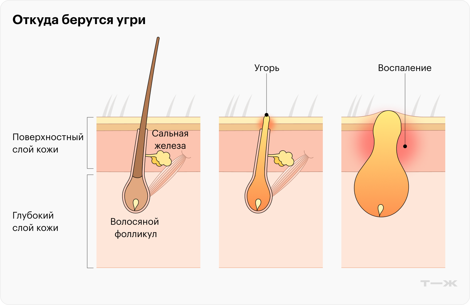 Когда пробка из кожного сала и омертвевших клеток закупоривает волосяной фолликул, «замурованные» внутри бактерии вызывают иммунный ответ и на коже появляется гнойник