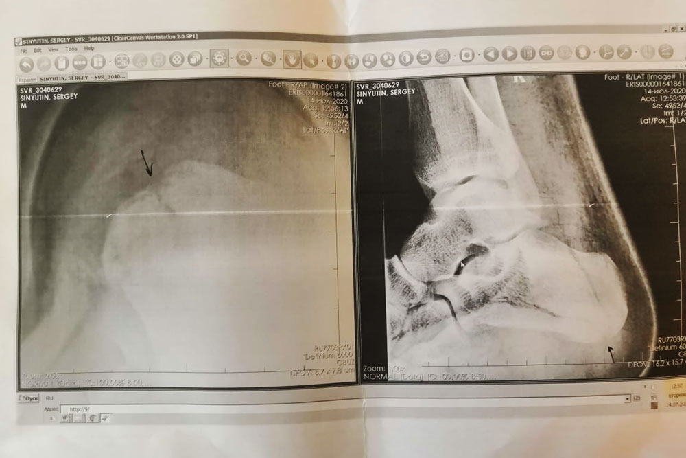 Автор статьи о переломе пятки проиллюстрировал ее собственными рентгеновскими снимками