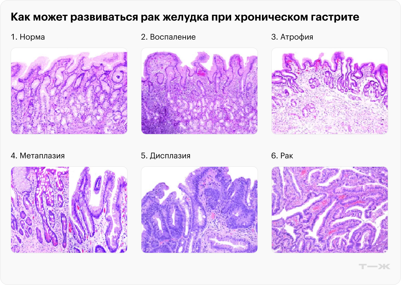 Так может развиваться рак желудка при хроническом гастрите. Длительное воспаление вызывает атрофию клеток, потом их предраковые изменения — метаплазию и дисплазию, а в итоге рак