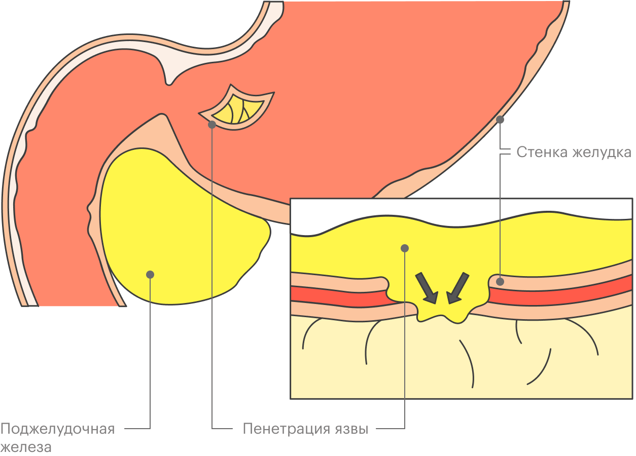 При пенетрации язвы желудка кислота начинается просачиваться в соседний орган, обычно поджелудочную железу