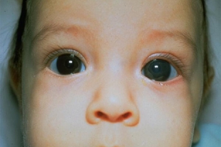 Так выглядят глаза при глаукоме у ребенка: роговица замутненная, глаза неестественно большие. Источник: botkin.pro