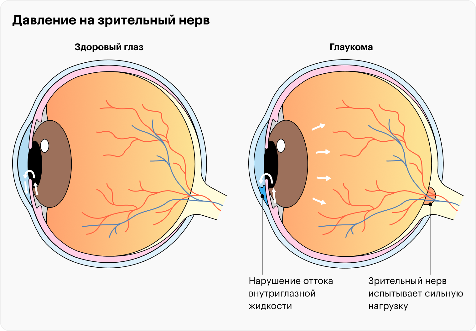 Что такое глазное давление?