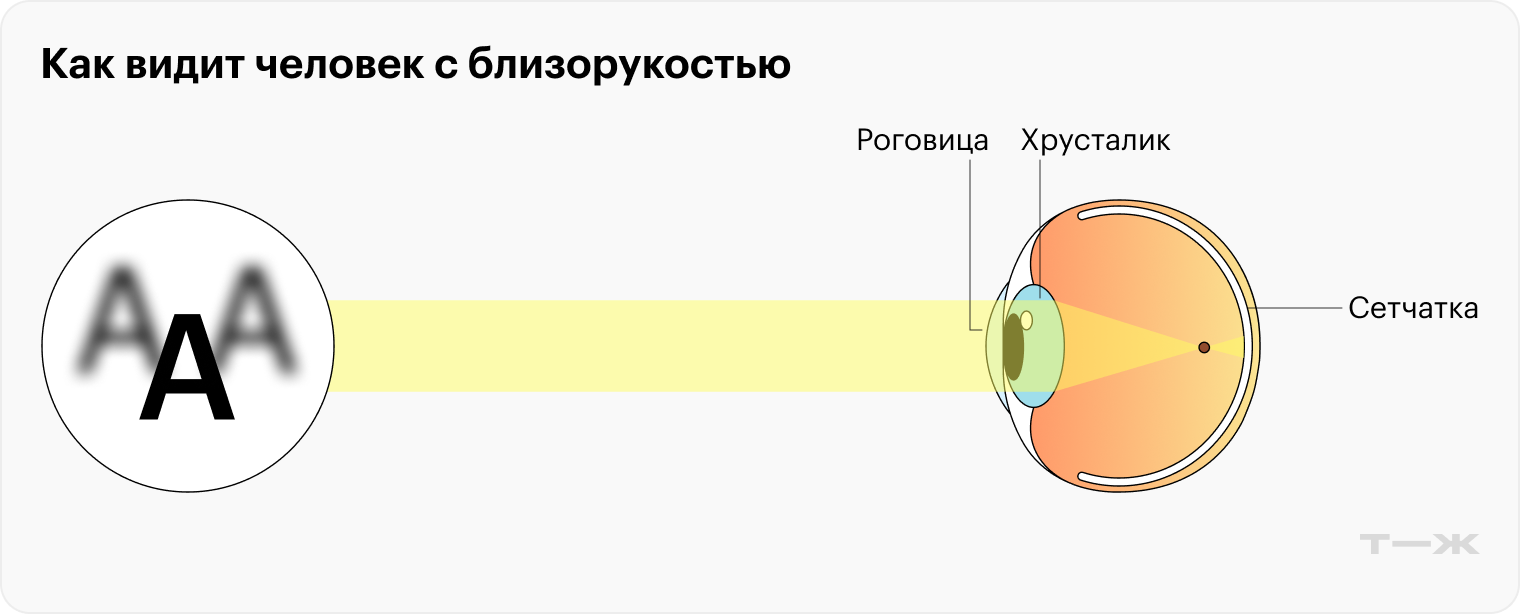 У человека с близорукостью изображение фокусируется не на сетчатке глаза, а перед ней — из-за того, что форма глазного яблока не такая, как нужно