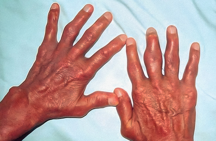 Тофусы чаще формируются на тыльной стороне пальцев рук, ног, на ушных раковинах, вокруг локтей, на пятках и над коленом. Источник: BMJ Journals