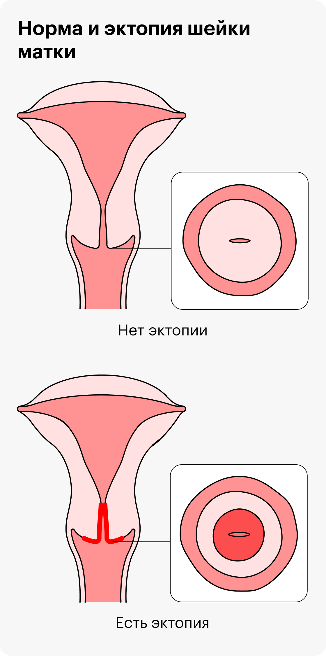 Эктопия шейки матки — нормальное состояние, которое обычно не надо лечить