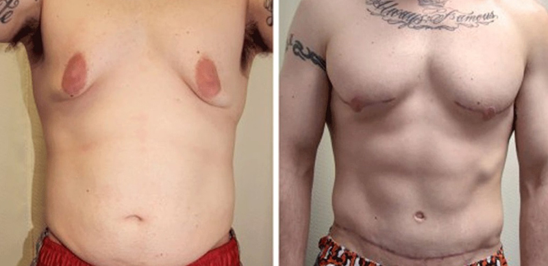 Гинекомастия: почему у мальчиков увеличивается грудь