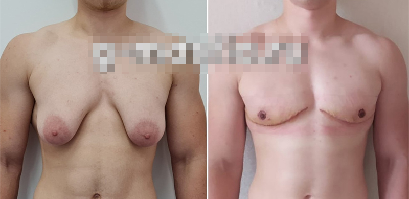 Фото до и после при применении метода лучей при лечении гинекомастии. Источник: doctor-petrovich.ru