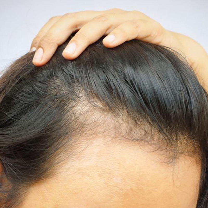 При диффузной алопеции волосы выпадают сильно и повсеместно. Впрочем, при должном лечении их можно вернуть в полном объеме. Источник: emb⁠-⁠beauty.ru
