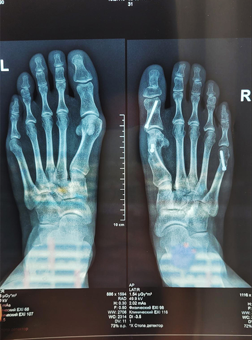 Вот так выглядит рентгеновский снимок стопы с винтами. Он сделан через три месяца после операции на правую ногу