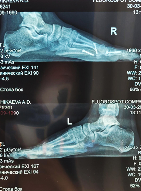 Вот так выглядит рентгеновский снимок стопы с винтами. Он сделан через три месяца после операции на правую ногу