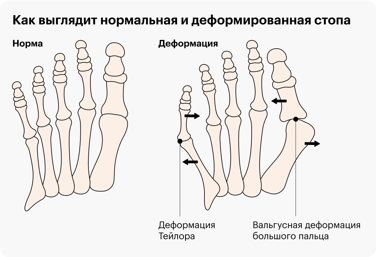 Лечение косточек на ногах