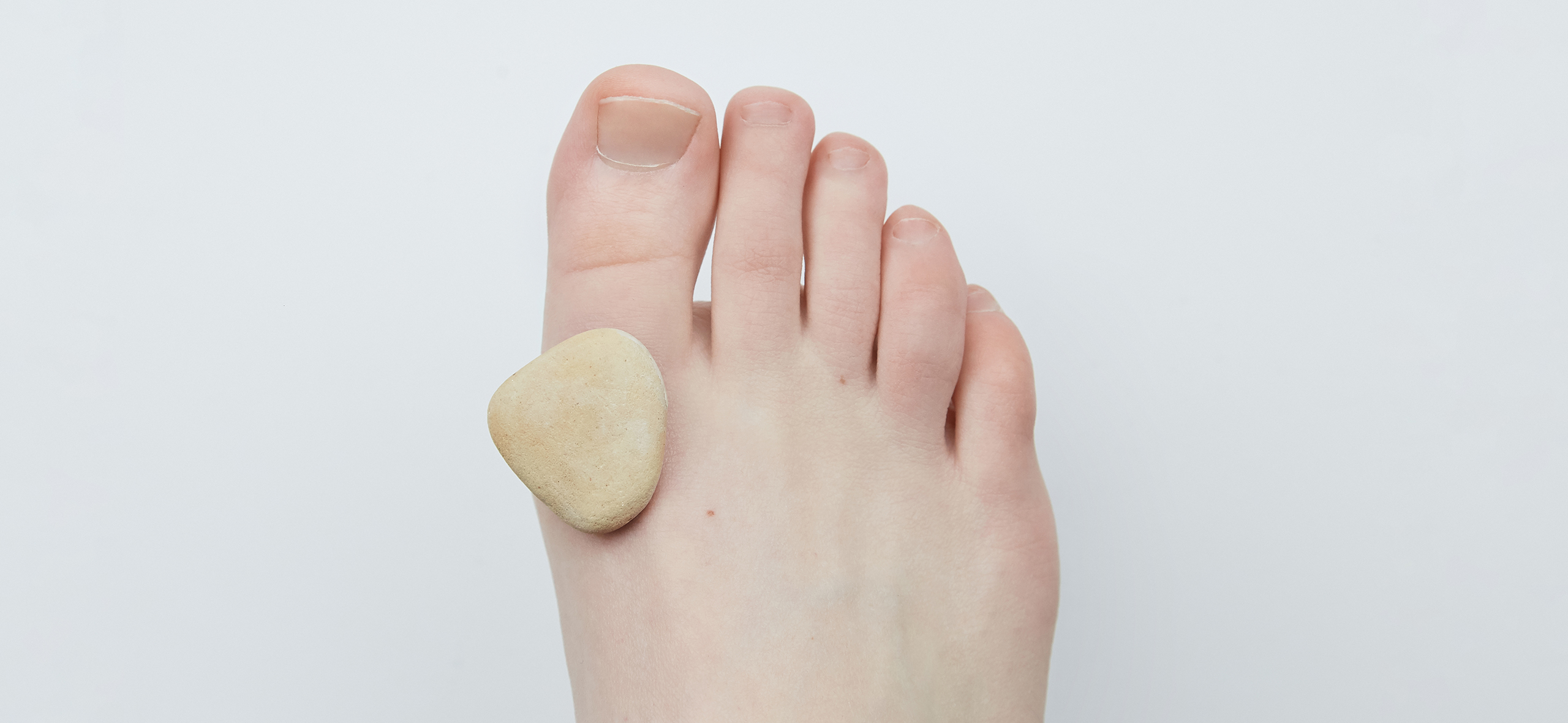 Как я бесплатно сделала две операции, чтобы удалить косточки на ногах