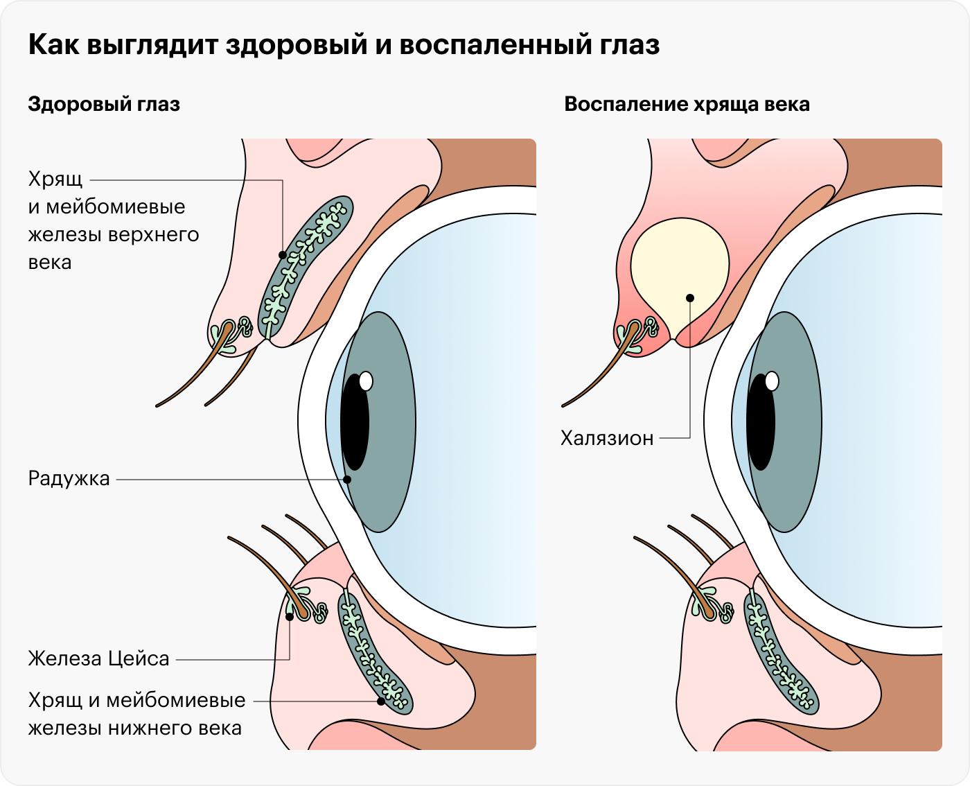 Что такое халязион и ячмень?