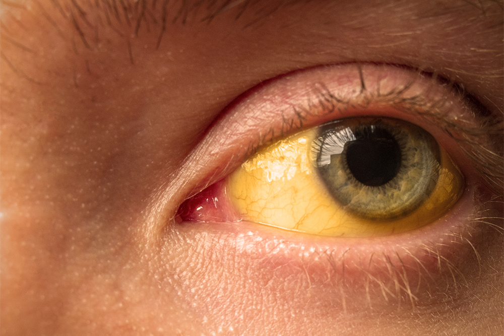 Также обычно желтеют склеры глаз. Источник: daniiD / Shutterstock