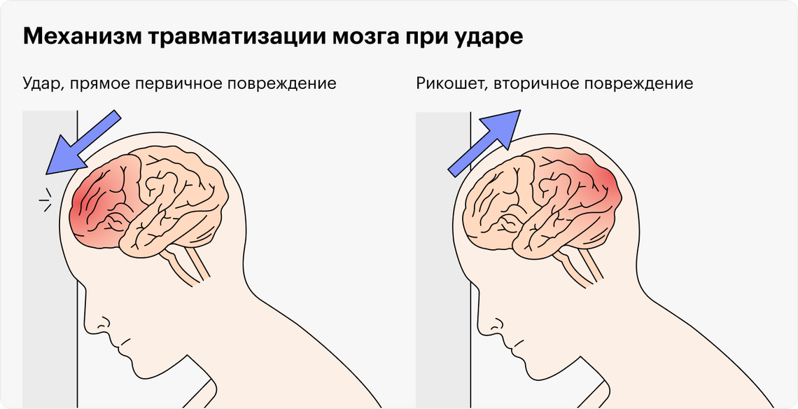 Сотрясение головного мозга - нарушение функций головного мозга, которое наступает вследствие травмы