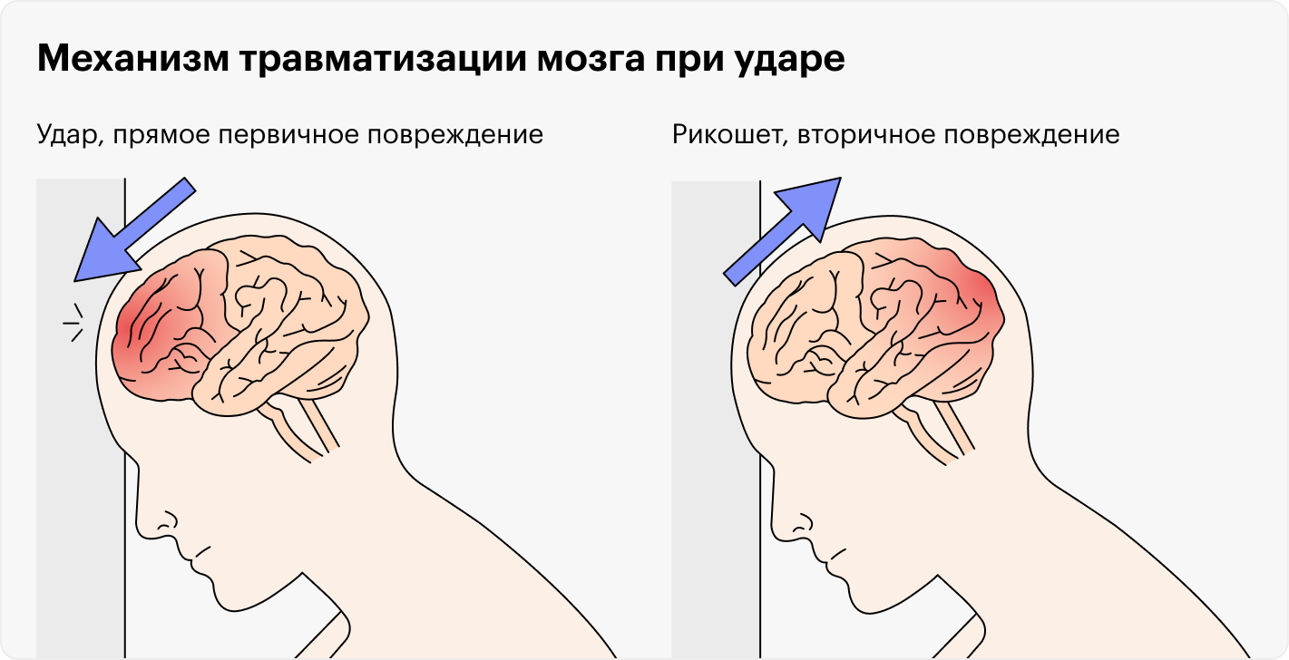 Сотрясение мозга у детей до года. Сотрясение головы и головного мозга. Если сильно ударился головой. Сотрясение и ушиб головного мозга.