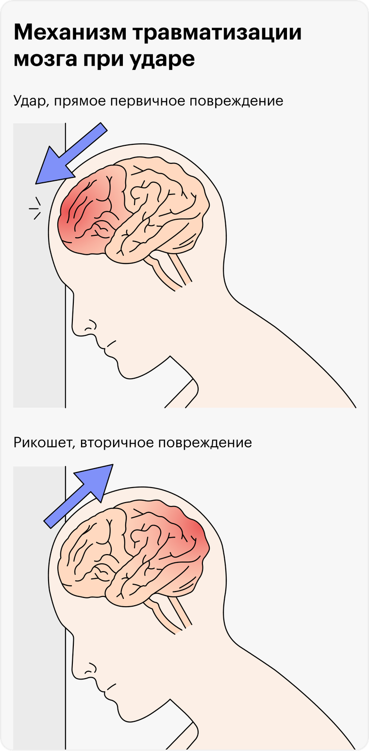 Что родителям нужно знать о черепно-мозговых травмах у детей и подростков