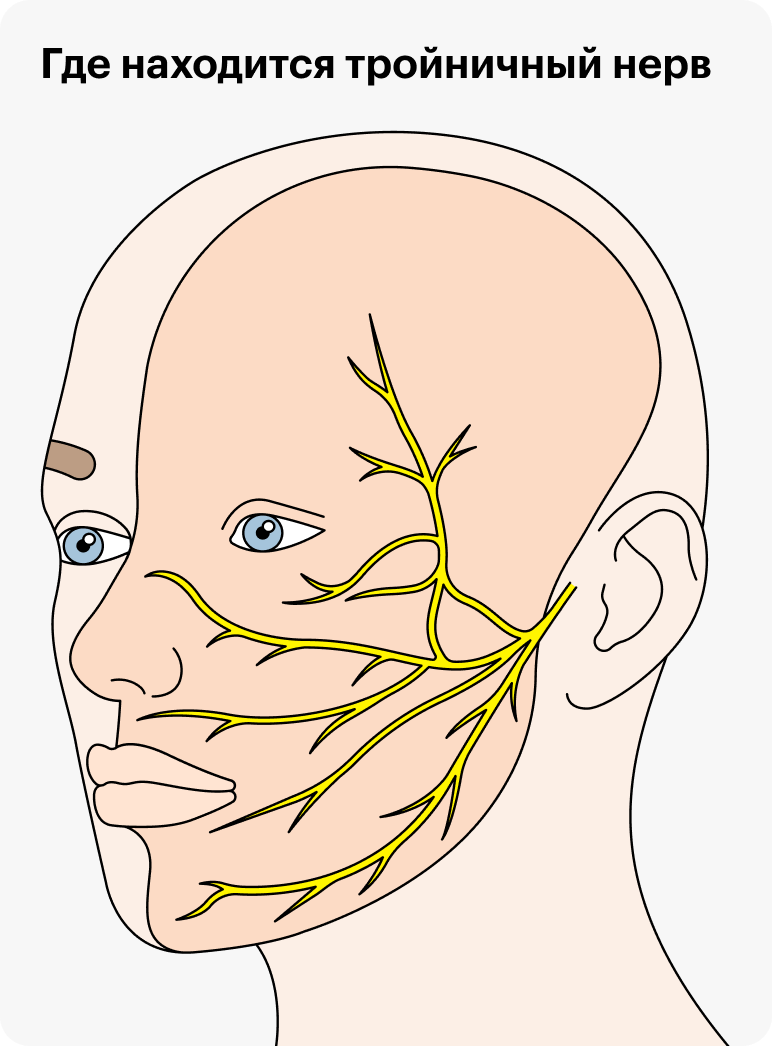 Ветви тройничного нерва отвечают за чувствительность в области головы. Активация ядра нерва в головном мозге может быть причиной мигрени