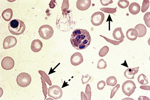 Серповидные эритроциты при одной из наследственных анемий — серповидноклеточной. Источник: uptodate.com