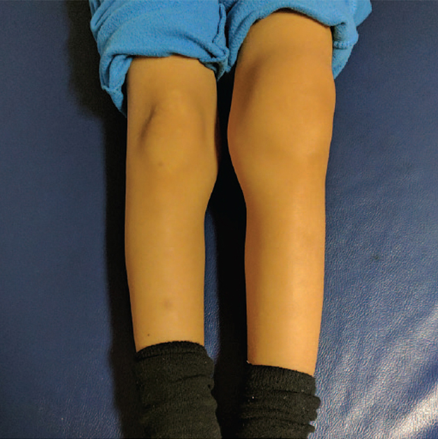 Гемартроз левого коленного сустава у ребенка с гемофилией. Источник: EFORT