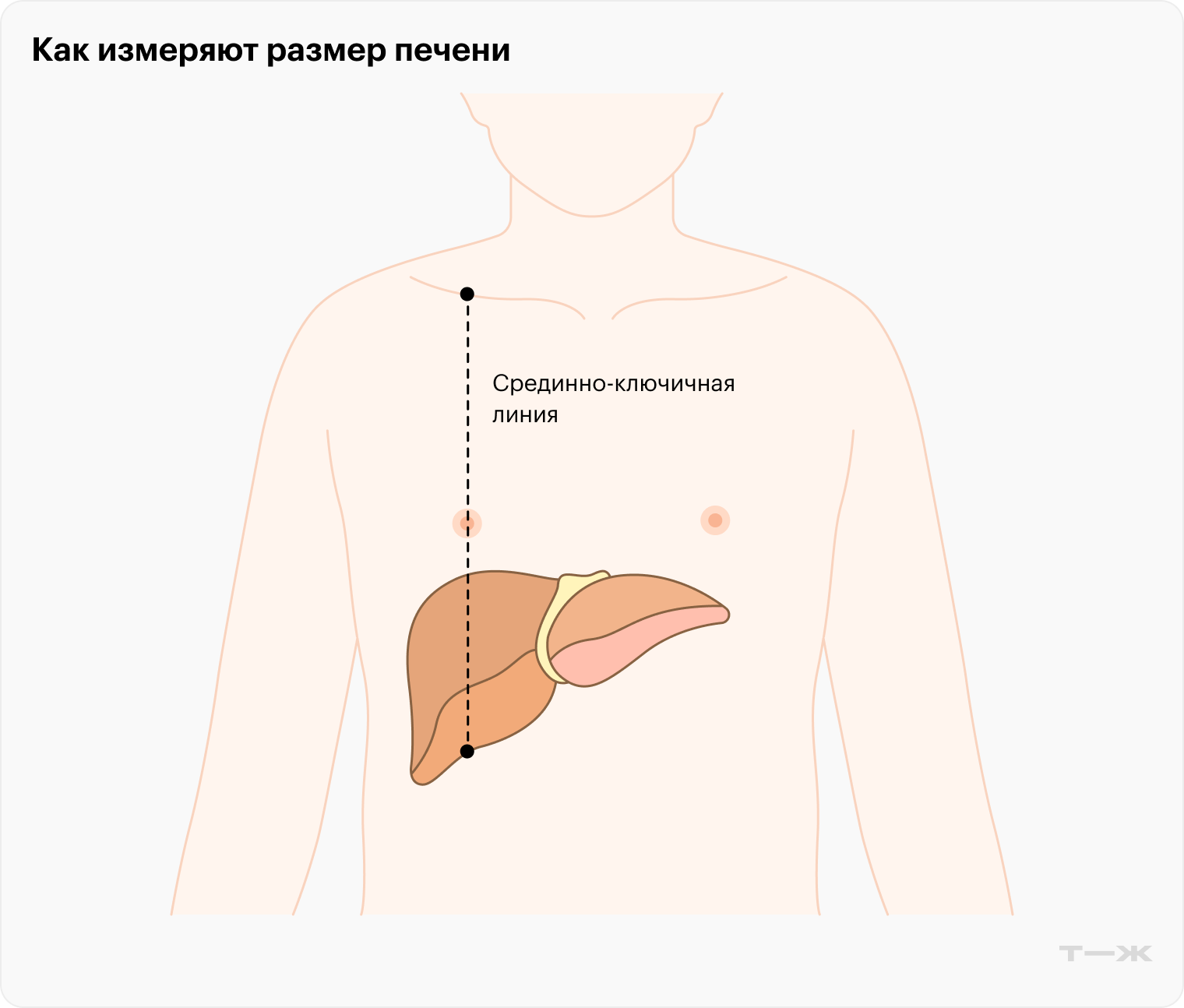 Желтой прерывистой линией обозначена срединно-ключичная линия