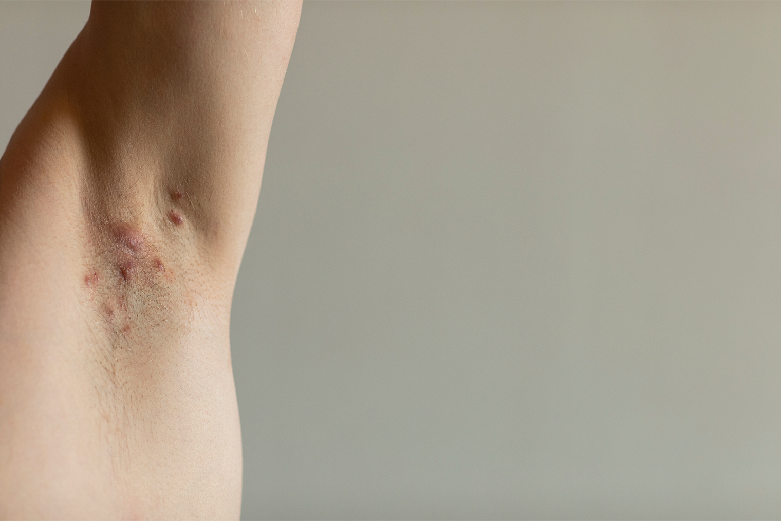 А так выглядят воспаленные участки при гидрадените. Обычно шишки не очень большие, но в то же время болезненные. Фотография: Lea Rae / Shutterstock / FOTODOM