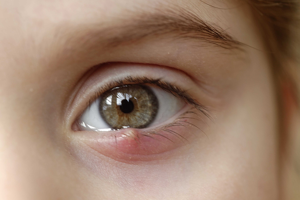 Лечение глаз народными средствами — чем опасно?