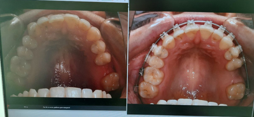 Сравнение зубного ряда в начале лечения в марте 2021 года (слева) и в июле 2022.