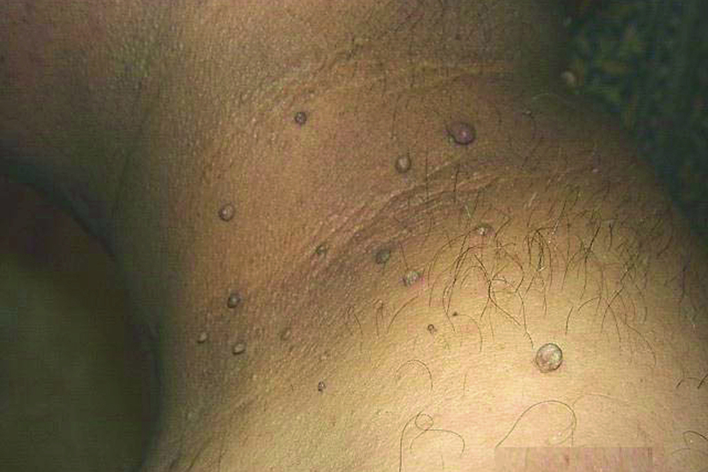 Мягкие фибромы кожи шеи, которые не имеют отношения к ВПЧ. Источник: msdmanuals.com