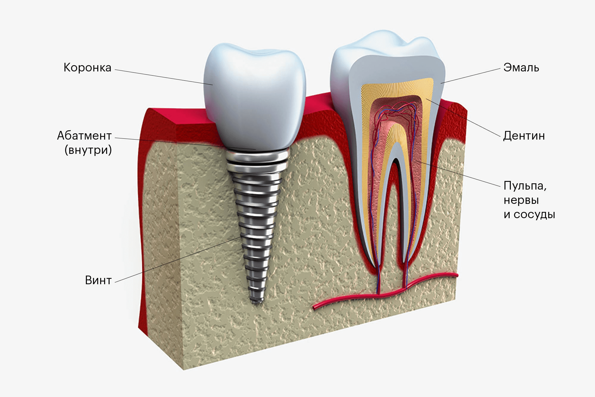 Имплантат похож на схематичный зуб. Главное отличие — внутри коронки нет кровеносных сосудов и нервов, а вместо живого корня — металлический винт