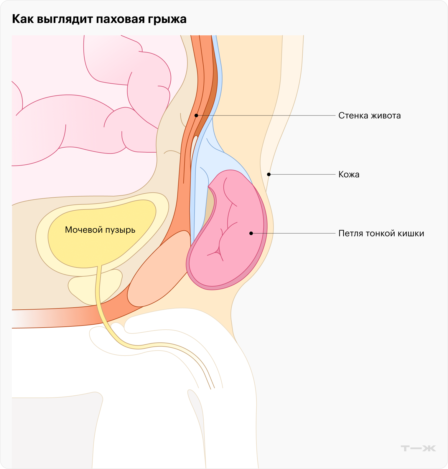 Растяжение паховых связок: как лечить, симптомы