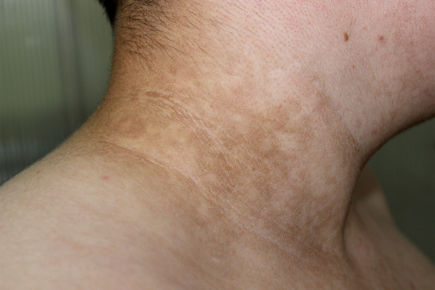 Черный акантоз у мужчины с диабетом. Источник: Dermatology11 / Shutterstock