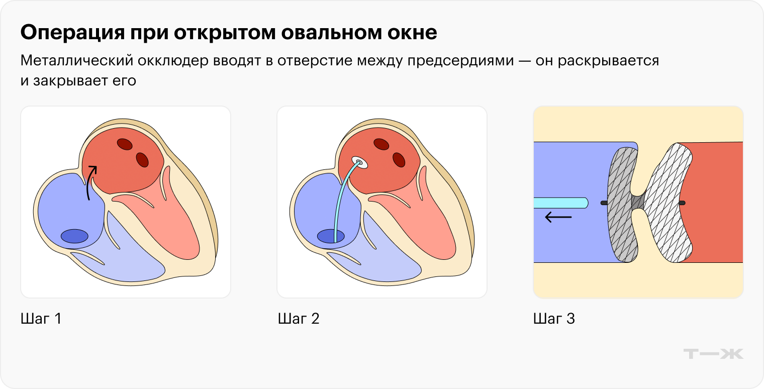 Например, окклюдеры используют при закрытии открытого овального окна или дефекта межпредсердной перегородки