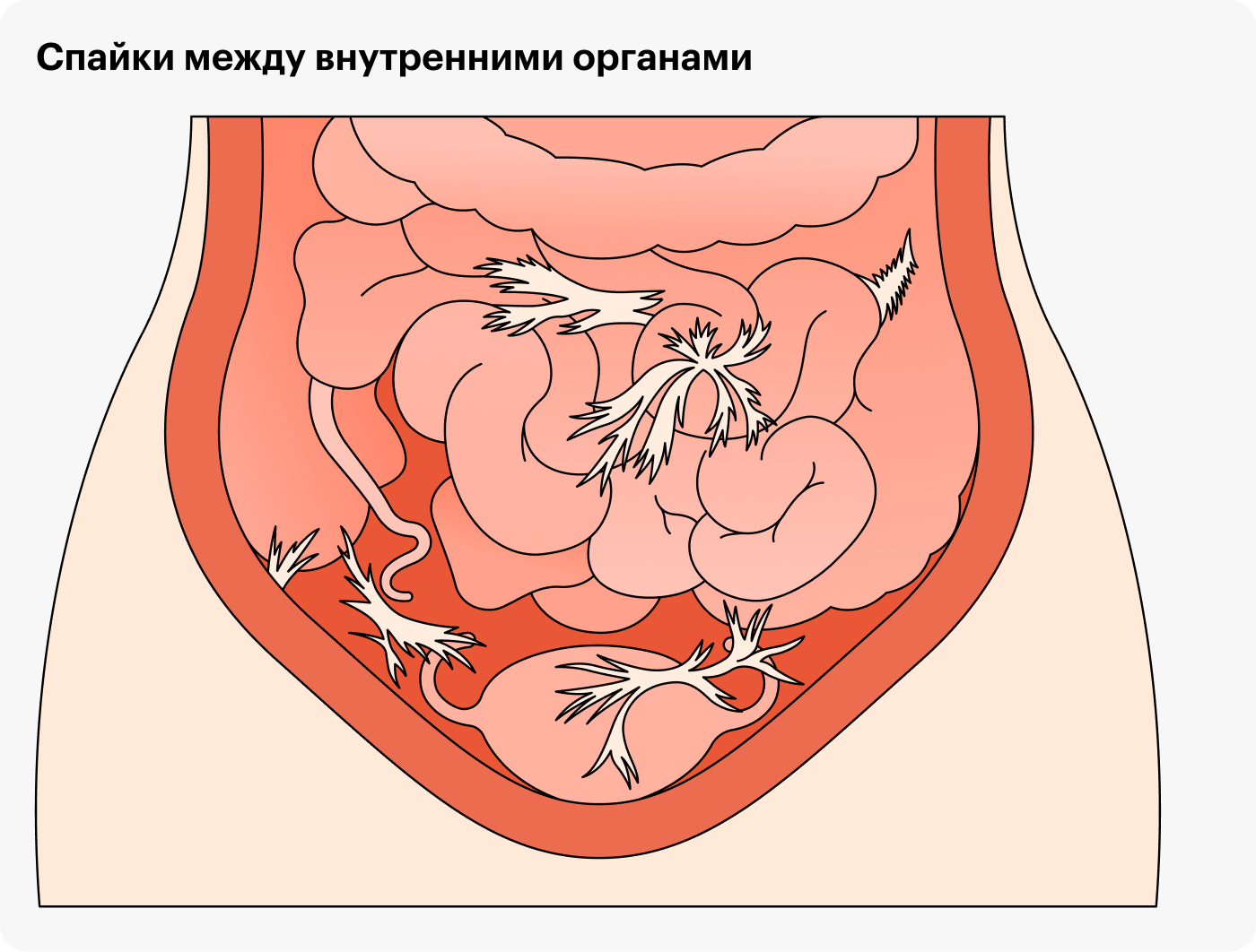 Спайки после операции: что это, симптомы, лечение, как избежать спаечной  болезни