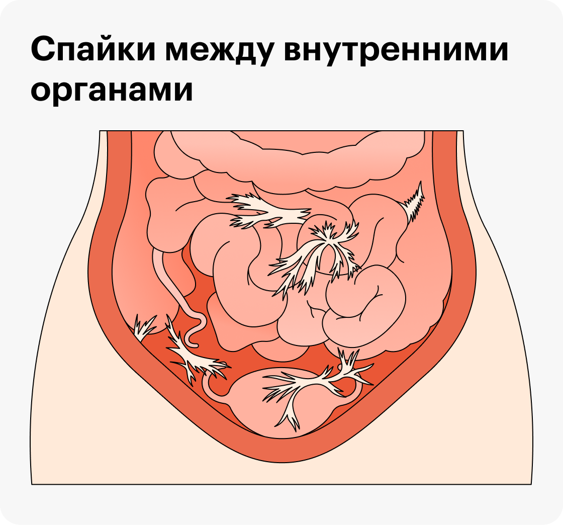 Тазовые перитонеальные спайки у женщин